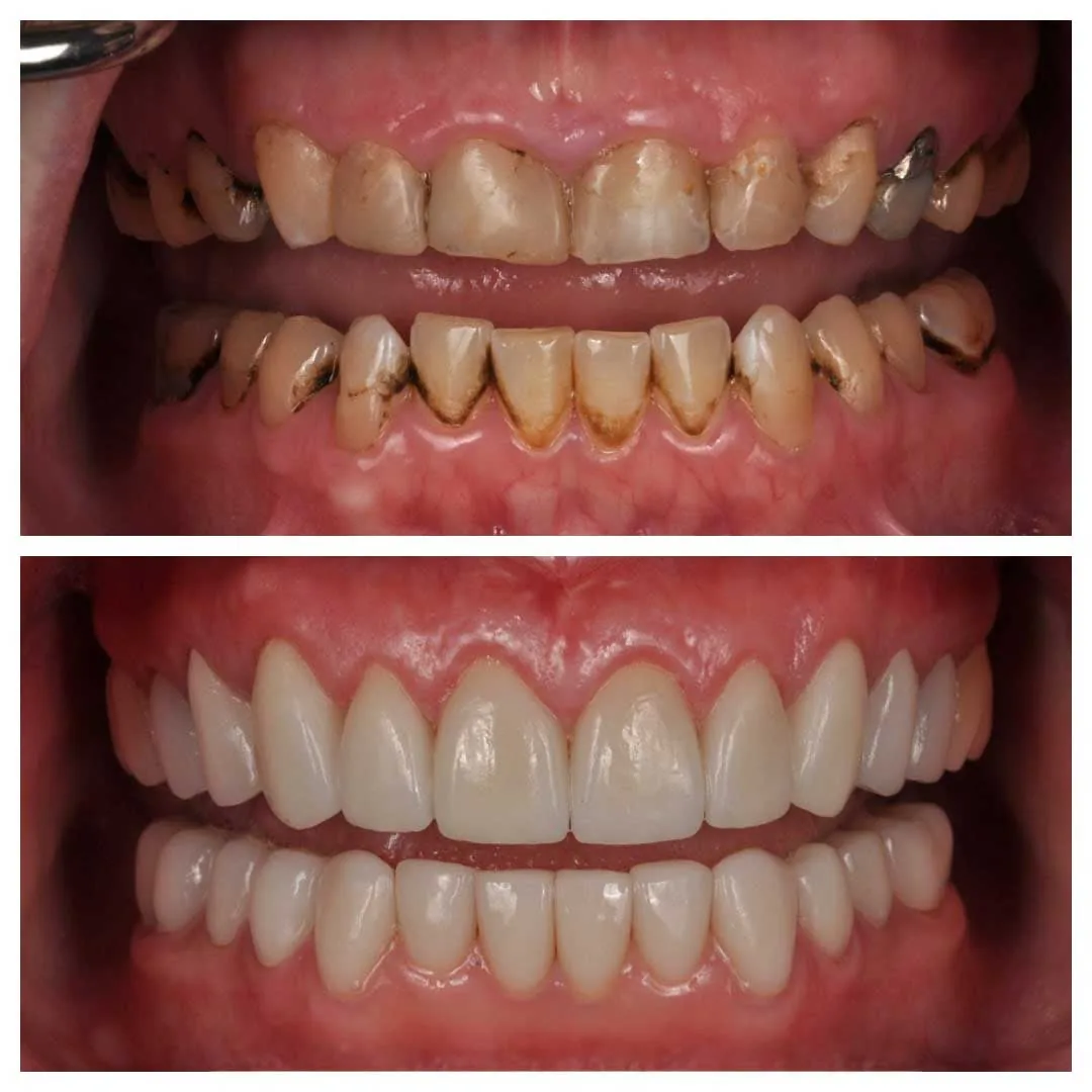 All-on-X full arch smile transformation — illustrative example